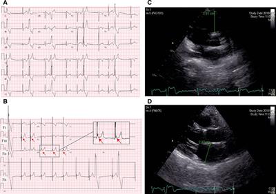 Case Report: Identification of novel CDH2 mutation (p. P183A het)-induced arrhythmogenic cardiomyopathy in China